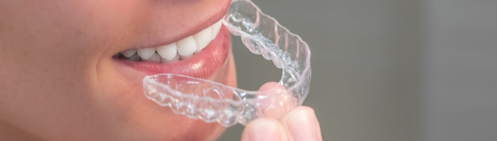 L’alignement des dents par gouttières invisibles