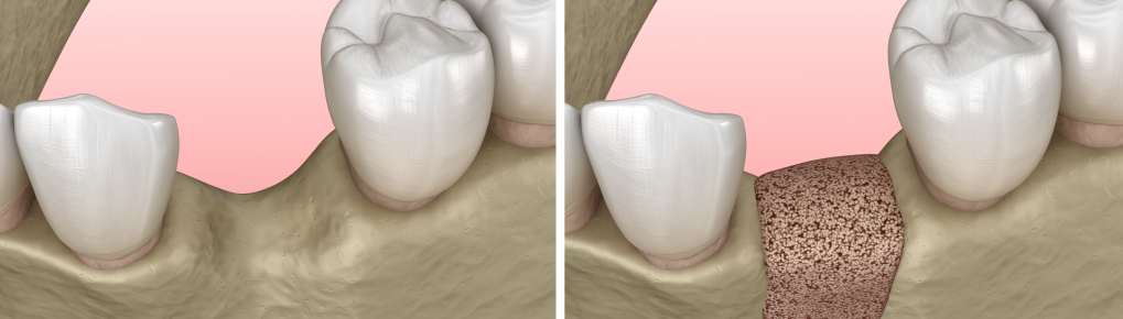 Reconstruction osseuse et gingivale